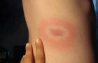 'I Believe Americans Have a Right to Know': New Jersey Representative Presents Bill Asking Government to Disclose Its Involvement in Lyme Disease 1 Bullseye Lyme Disease Rash