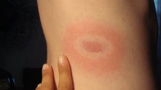 Bullseye Lyme Disease Rash