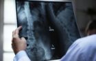 Spinal implant helps three paralyzed men walk again 2 spinal cord spine back